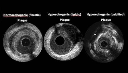 IVUS